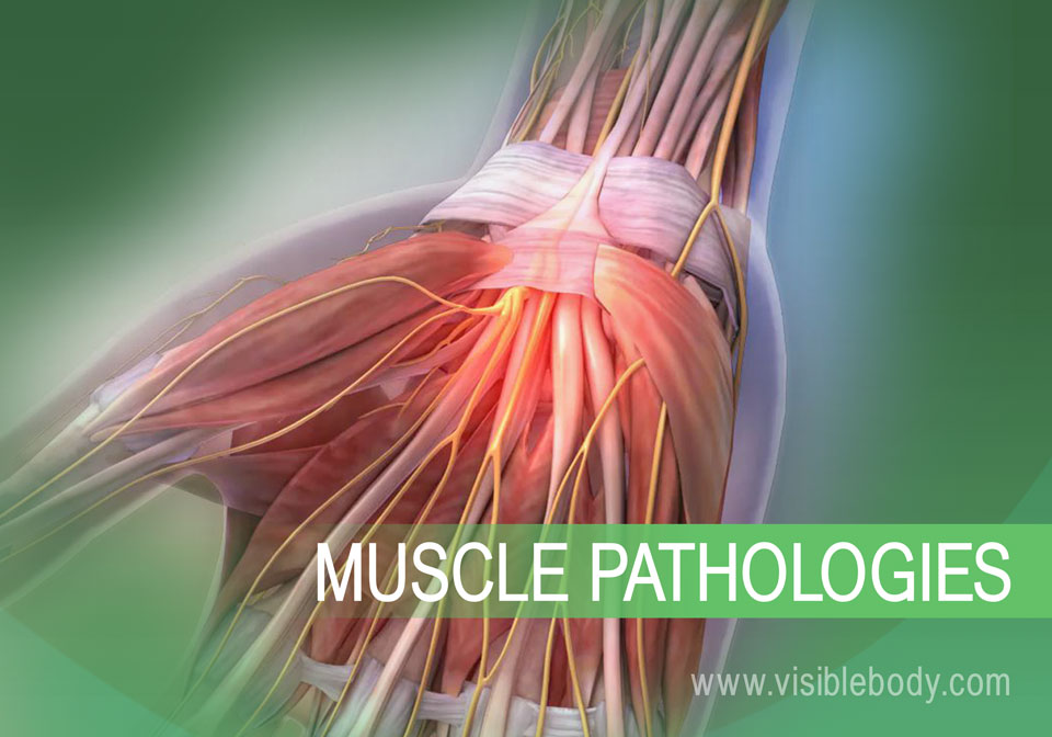 Muscular System Pathologies Muscular System Pathologies